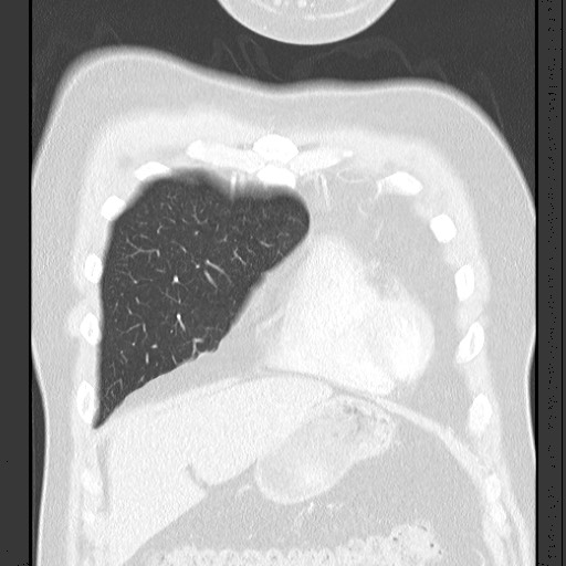 Bronchial carcinoid tumor (Radiopaedia 67377-76764 Coronal lung window 21).jpg