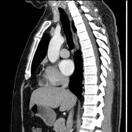 Bronchial carcinoid tumor (Radiopaedia 67377-76764 E 34).jpg
