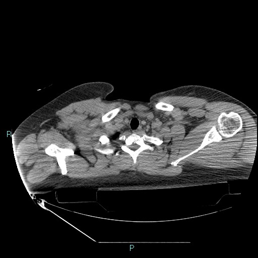 Bronchial carcinoid tumor (Radiopaedia 78272-90870 Axial non-contrast 8).jpg