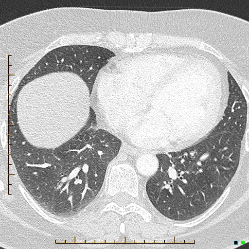 File:Bronchial diverticula (Radiopaedia 79512-92676 Axial lung window 139).jpg