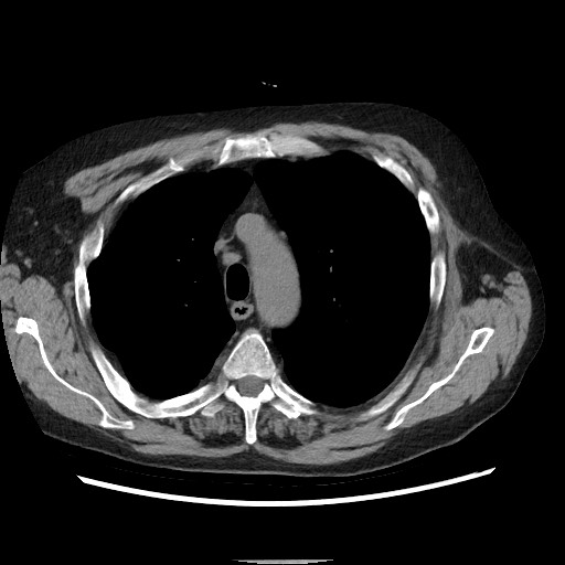 Bronchial stenosis - lung transplant (Radiopaedia 73133-83848 Axial non-contrast 19).jpg