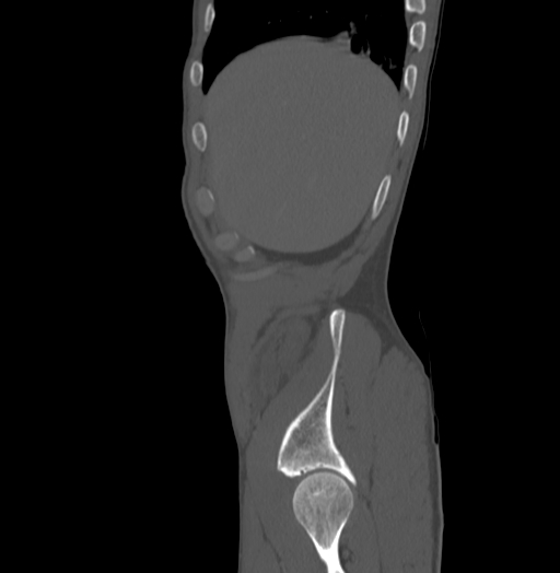 Bronchiectasis in Crohn disease (Radiopaedia 60311-67977 Sagittal bone window 2).jpg