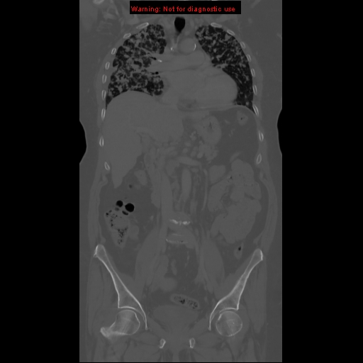 File:Bronchoalveolar carcinoma (Radiopaedia 13224-13233 Coronal non-contrast 6).jpg