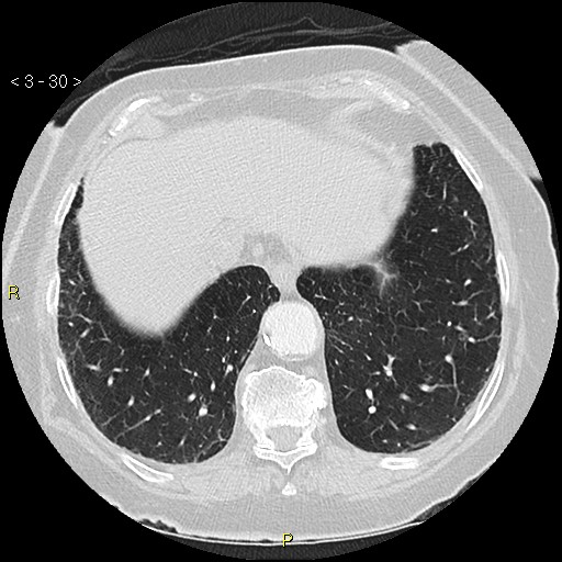 Bronchogenic carcinoma as an incidental finding (Radiopaedia 16453-16130 Axial lung window 30).jpg
