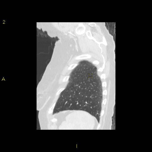 File:Bronchogenic carcinoma as an incidental finding (Radiopaedia 16453-16130 Sagittal lung window 9).jpg