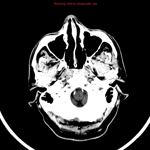 File:Bronchogenic carcinoma brain metastasis (Radiopaedia 9286-9970 B 3).jpg