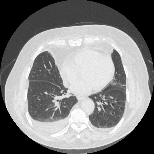 File:Bronchogenic carcinoma with metastatic lymphadenopathy (Radiopaedia 37671-39569 Axial lung window 36).jpg