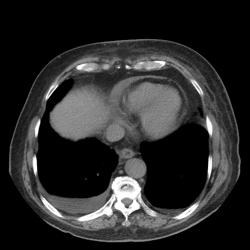 Bronchogenic carcinoma with metastatic lymphadenopathy (Radiopaedia 37671-39569 Axial non-contrast 42).jpg