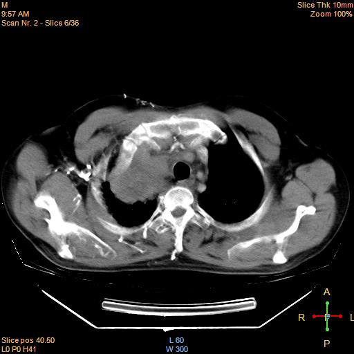 File:Bronchogenic carcinoma with superior vena caval invasion (Radiopaedia 22378-22406 Axial liver window 4).jpg