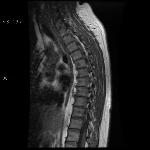File:Bronchogenic cyst - posterior mediastinal (Radiopaedia 43885-47365 Sagittal T1 16).jpg