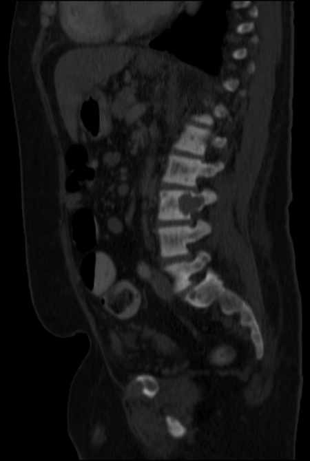 Brown tumors compressing the spinal cord (Radiopaedia 68442-77988 H 33).jpg