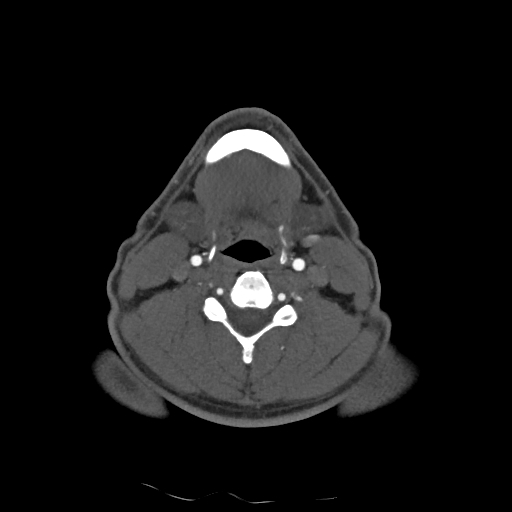 Buccal fat pad arteriovenous malformation (Radiopaedia 70936-81144 A 71).jpg