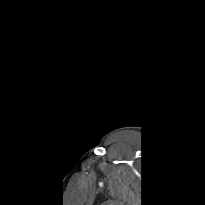 Buccal fat pad arteriovenous malformation (Radiopaedia 70936-81144 C 3).jpg