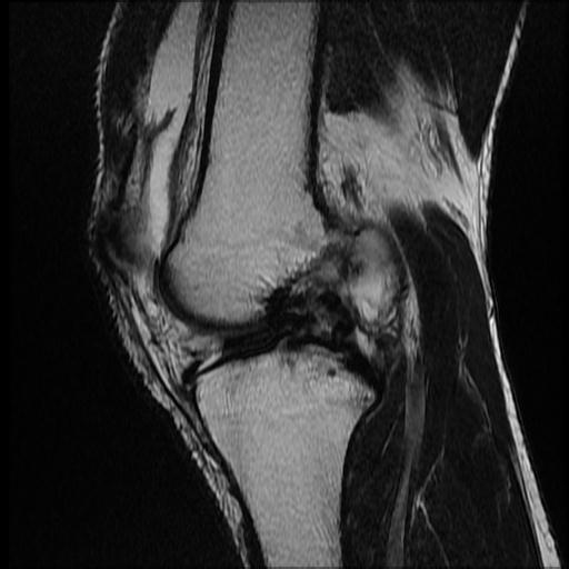 File:Bucket handle tear - medial meniscus (Radiopaedia 69245-79026 Sagittal T2 8).jpg