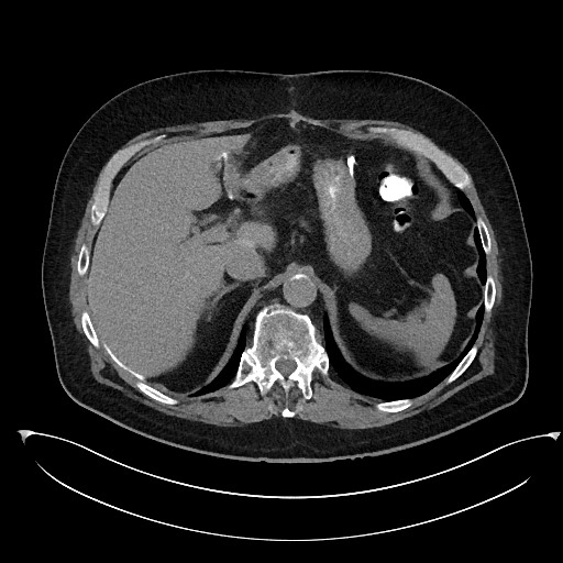 File:Buried bumper syndrome - gastrostomy tube (Radiopaedia 63843-72577 Axial Inject 23).jpg