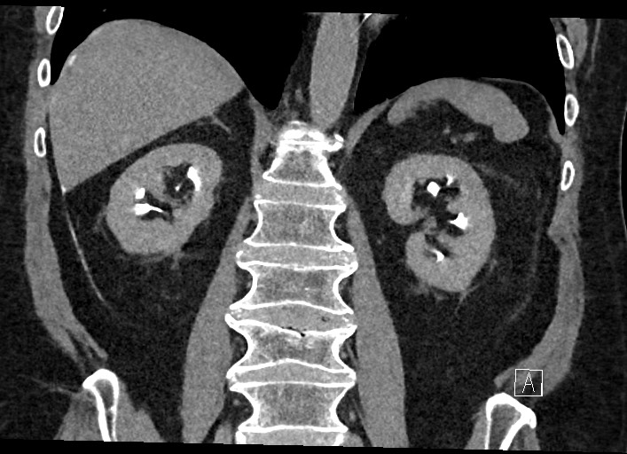 Buried bumper syndrome - gastrostomy tube (Radiopaedia 63843-72577 Coronal Inject 89).jpg