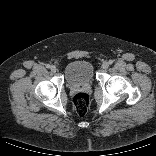 File:Burned-out testicular seminoma - retroperitoneal nodal metastases (Radiopaedia 62872-71245 A 69).jpg