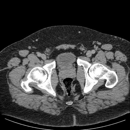 Burned-out testicular seminoma - retroperitoneal nodal metastases (Radiopaedia 62872-71245 A 70).jpg