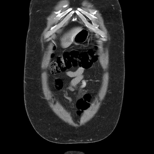 Burned-out testicular seminoma - retroperitoneal nodal metastases (Radiopaedia 62872-71245 B 11).jpg