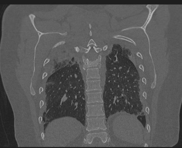 Burst fracture - thoracic spine (Radiopaedia 30238-30865 Coronal bone window 125).jpg