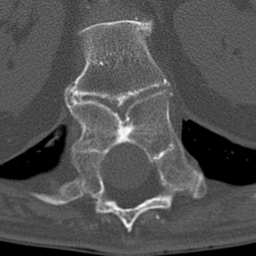 Butterfly vertebrae with kyphoscoliosis (Radiopaedia 14257-14133 Axial bone window 55).jpg