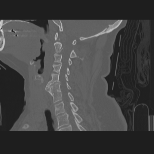 C2 fracture (Radiopaedia 34091-35341 Sagittal bone window 43).png