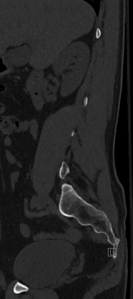 Calcaneal fractures with associated L2 burst fracture (Radiopaedia 71671-82493 Sagittal bone window 69).jpg