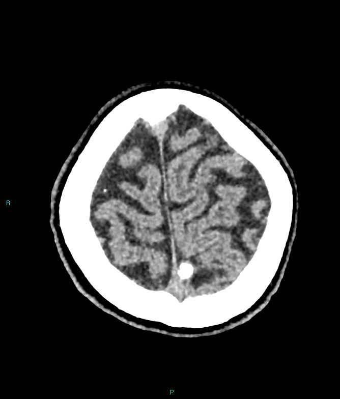 Calcified cerebral emboli from left ventricular thrombus (Radiopaedia 84420-99758 Axial non-contrast 15).jpg