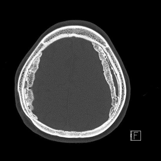 Calcified chronic subdural hematoma (Radiopaedia 77374-89492 Axial bone window 107).jpg