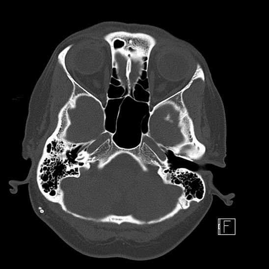 Calcified chronic subdural hematoma (Radiopaedia 77374-89492 Axial bone window 24).jpg