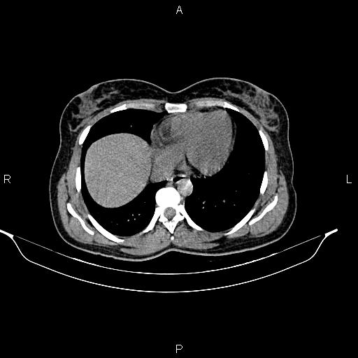 File:Calcified hepatic hydatid cyst (Radiopaedia 84672-100095 Axial non-contrast 10).jpg