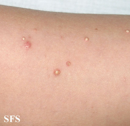 Calcinosis Cutis (Dermatology Atlas 9).jpg