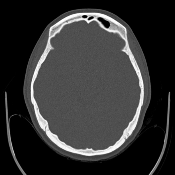 Calvarial osteoma (Radiopaedia 36520-38079 Axial bone window 45).jpg