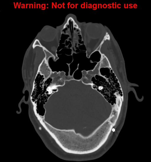 File:Calvarial thickening from chronic shunting (Radiopaedia 60079-67637 Axial bone window 47).jpg