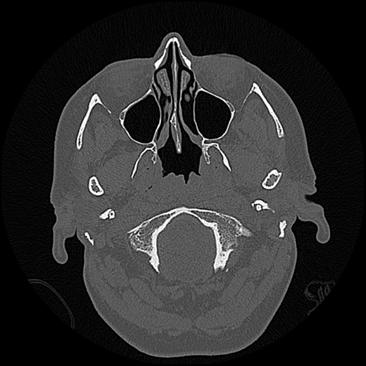 Canal up mastoidectomy (Radiopaedia 78108-90638 Axial bone window 13).jpg