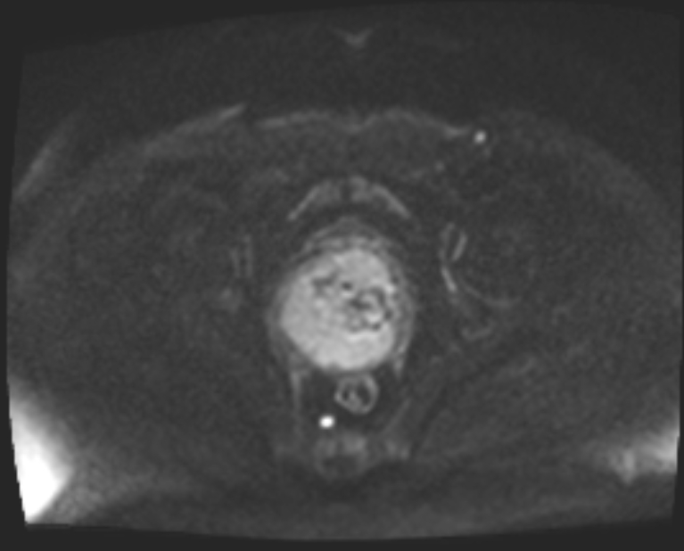 Cancer cervix - stage IIb (Radiopaedia 75411-86615 Axial DWI 68).jpg