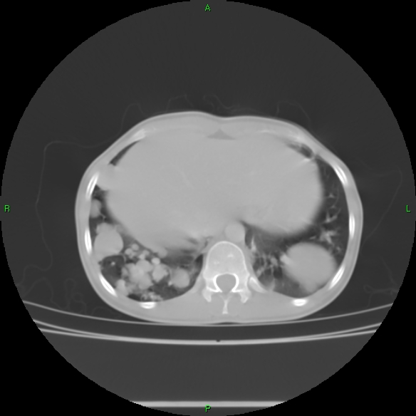 File:Cannon ball metastases - synovial sarcoma (Radiopaedia 26135-26271 Axial lung window 31).jpg