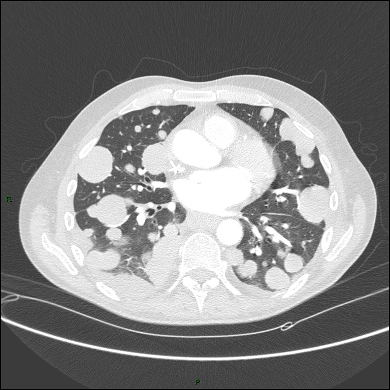 Cannonball metastases (Radiopaedia 82110-96150 Axial lung window 113).jpg