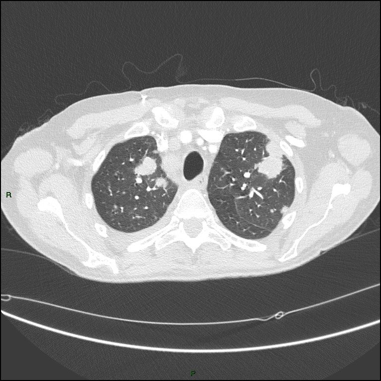 Cannonball metastases (Radiopaedia 82110-96150 Axial lung window 50).jpg