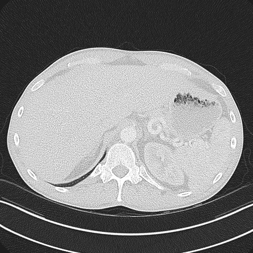 Cannonball metastases - testicular choriocarcinoma (Radiopaedia 84510-99891 Axial lung window 90).jpg