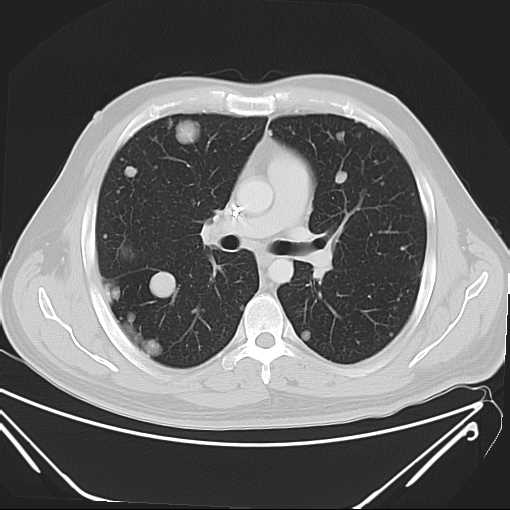 File:Cannonball pulmonary metastases (Radiopaedia 67684-77101 Axial lung window 11).jpg