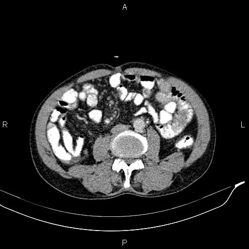 Caput medusae sign - portal hypertension (Radiopaedia 64007-72759 A 55).jpg