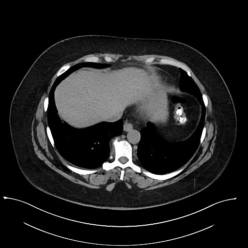 Carcinoid tumor - terminal ileum (Radiopaedia 60931-68740 Axial non-contrast 3).jpg