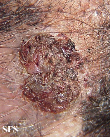 Carcinoma-Verrucous Carcinoma (Dermatology Atlas 2).jpg