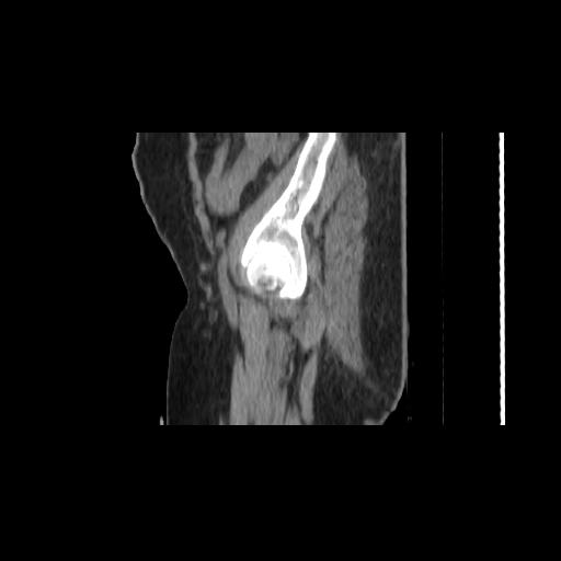 Carcinoma cervix- brachytherapy applicator (Radiopaedia 33135-34173 D 13).jpg