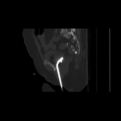 File:Carcinoma cervix- brachytherapy applicator (Radiopaedia 33135-34173 Sagittal bone window 110).jpg