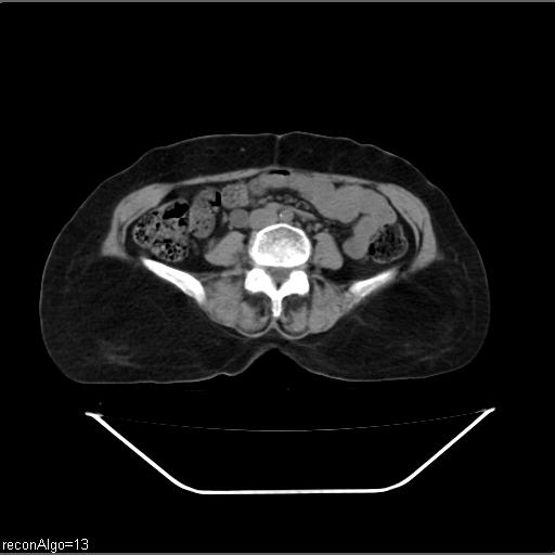 File:Carcinoma cervix- recurrence (Radiopaedia 34702-36137 Axial non-contrast 32).jpg