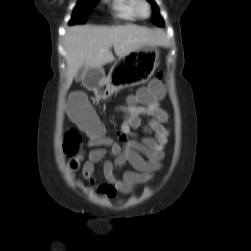 File:Carcinoma colon - hepatic flexure (Radiopaedia 19461-19493 B 7).jpg