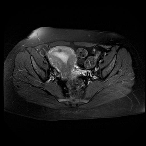 File:Carcinoma of the cervix (Radiopaedia 89018-105858 Axial T2 fat sat 7).jpg