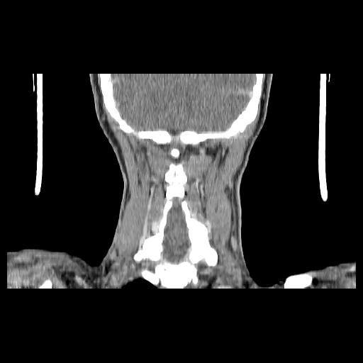 File:Carcinoma of the maxillary antrum (Radiopaedia 53805-59888 Coronal C+ delayed 134).jpg